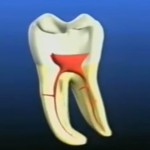 歯の神経を抜く根管治療の平均的な治療期間は？ポイントとは？